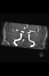 Hypophysenadenom-pre