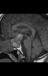 Hypophysenadenom_postop