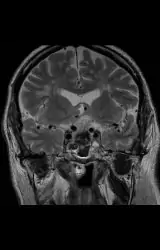 Hypophysenadenom_postop1