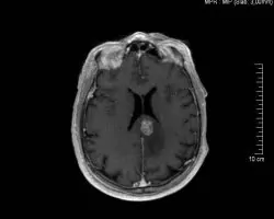 metastasi-egkefalou-1
