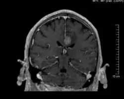 metastasi-egkefalou-2