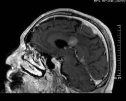 metastasi-egkefalou-9